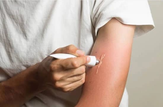 applying healing ointment on a sunburn