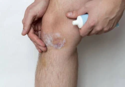 applying ointment to a bruise