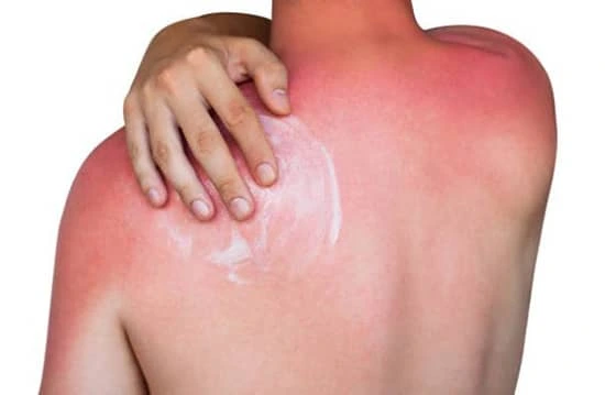 man applying burn cream to burn on shoulder