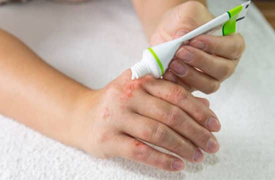 man applying hand repair cream to his hand